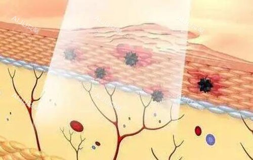 激光美肤作用展示 激光美肤作用展示