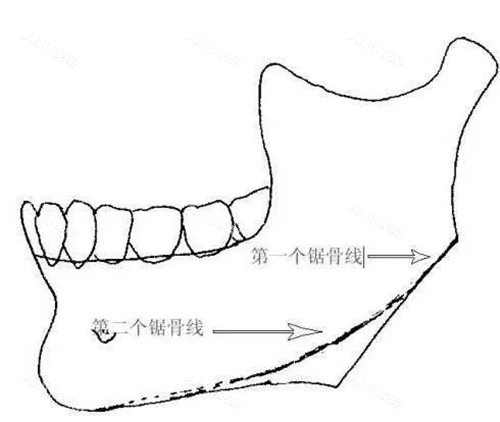 下颌骨截骨出现二次角示意图