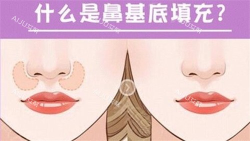 什么是鼻基底填充