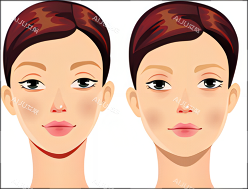 面部初期衰老下垂示例图 面部初期衰老下垂示例图