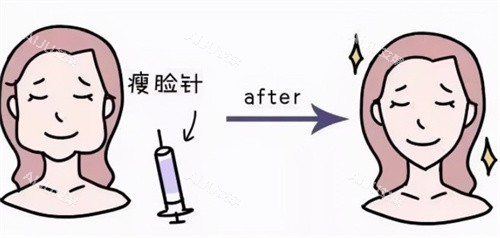 瘦脸注射前后卡通