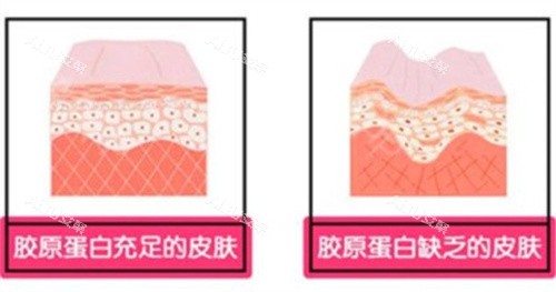 胶原蛋白填充的皮肤对比