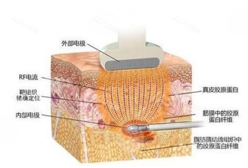 黄金射频微针的作用
