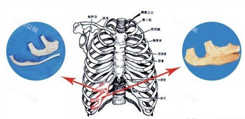 耳再造手术自体肋软骨