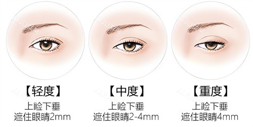 上睑下垂遮盖程度