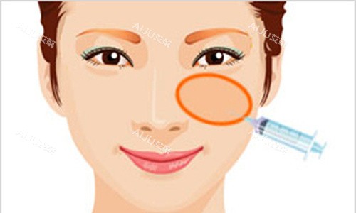 莫纳丽莎玻尿酸面部苹果肌填充图