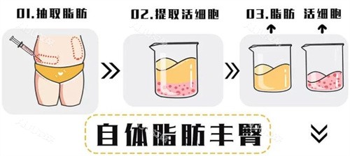 自体脂肪移植过程