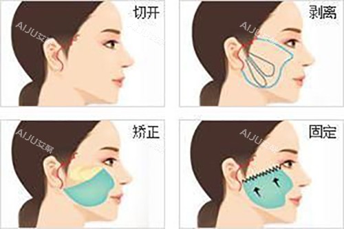 曹孟君整形哪个医生做小拉皮好？曹孟君做七层筋膜提升好|斯良洪的无张力缝合技术高
