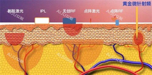 黄金微针射频
