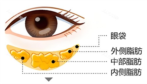 眶隔脂肪释放去眼袋问题形成因