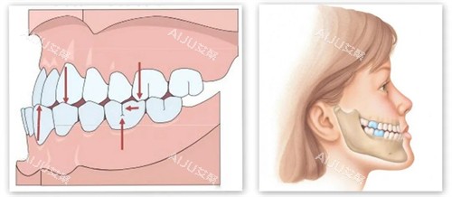 下巴内缩内部展示动画图 下巴内缩内部展示动画图