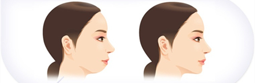 下巴内缩手术前后对比动画图 下巴内缩手术前后对比动画图