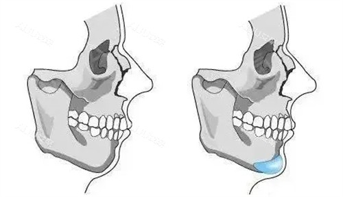 下巴内缩填充位置动画图 下巴内缩填充位置动画图