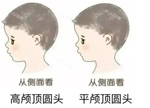 高颅顶和正常头的对比