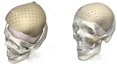 颅骨修复对比
