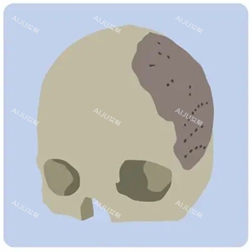 颅骨修复的对比动画图 颅骨修复的对比动画图