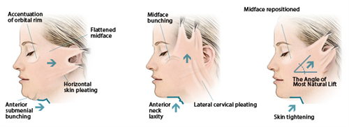 面部提升手术三种提升方向 面部提升手术三种提升方向