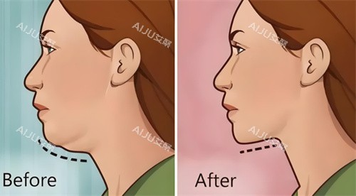 射频紧肤提升 射频紧肤提升