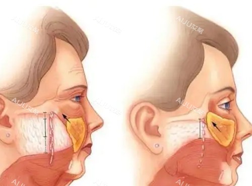 双面网兜术卡通示意图