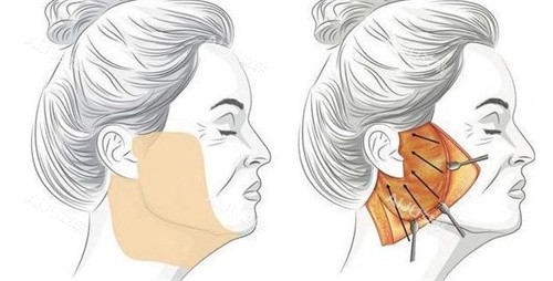 双面网兜术手术做法