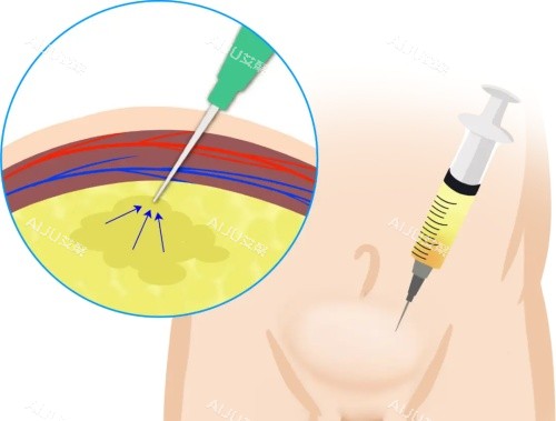 玻尿酸增粗 玻尿酸增粗