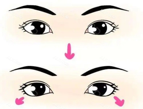 开眼角术前术后对比 开眼角术前术后对比