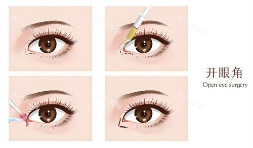 开内眼角演示动画图 开内眼角演示动画图