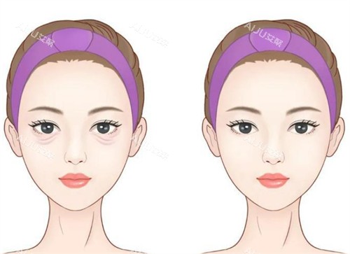 年轻祛眼袋前后对比 年轻祛眼袋前后对比