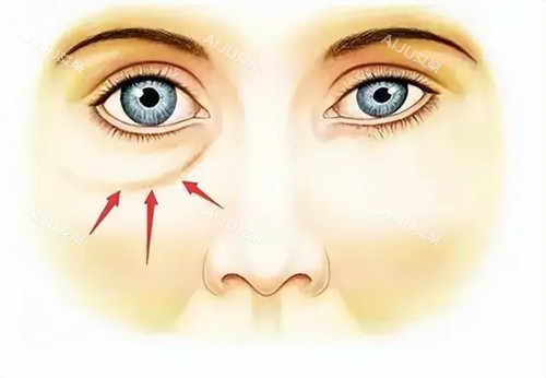 眼袋位置卡通示意图 眼袋位置卡通示意图