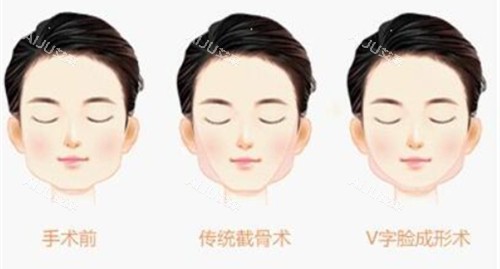 下巴宽大手术后<span style=