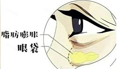 脂肪膨胀型眼袋 脂肪膨胀型眼袋