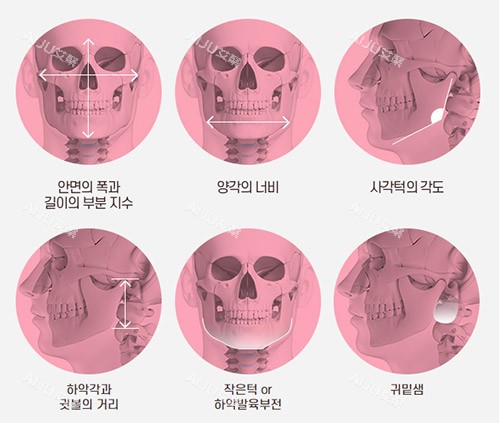 面部轮廓手术示意图 面部轮廓手术示意图