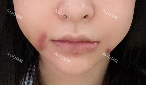 轮廓手术面部肿胀 轮廓手术面部肿胀