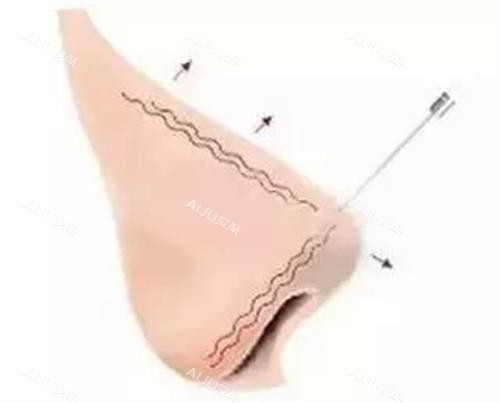 玻尿酸打鼻头示意图 玻尿酸打鼻头示意图