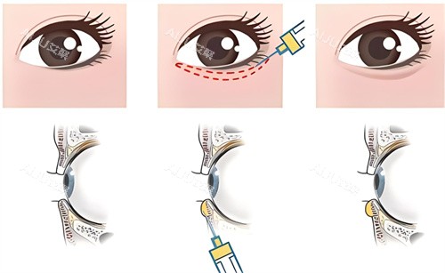 卧蚕填充原理 卧蚕填充原理
