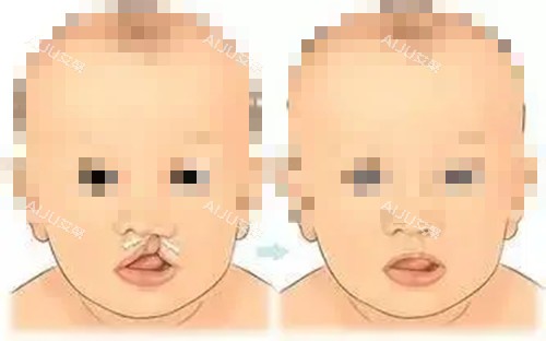 唇腭裂修复前后对比示意图 唇腭裂修复前后对比示意图