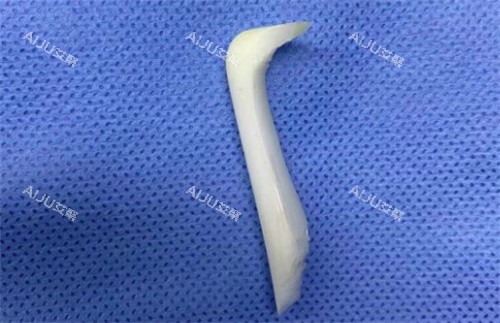 取出的隆鼻假体