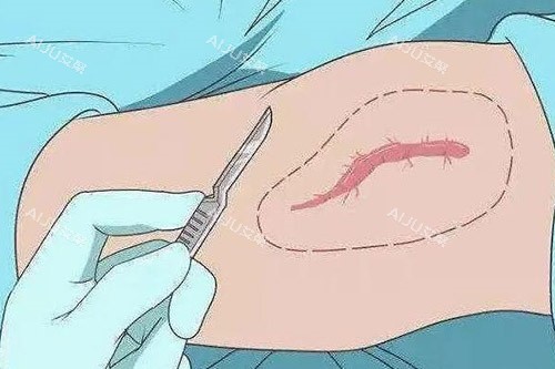 疤痕改善卡通图展示 疤痕改善卡通图展示