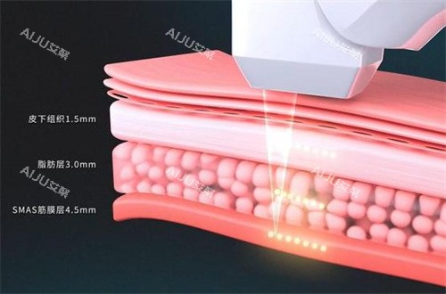 超声炮治疗深度 超声炮治疗深度