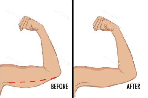 隔空溶脂手臂吸脂对比图 隔空溶脂手臂吸脂对比图