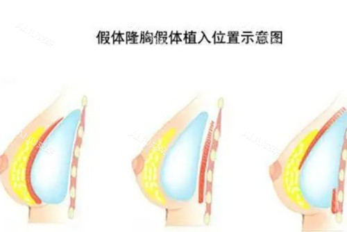 伊思雅假体隆胸示意图