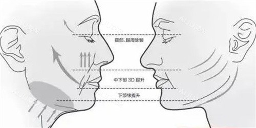 面部提升三大部位
