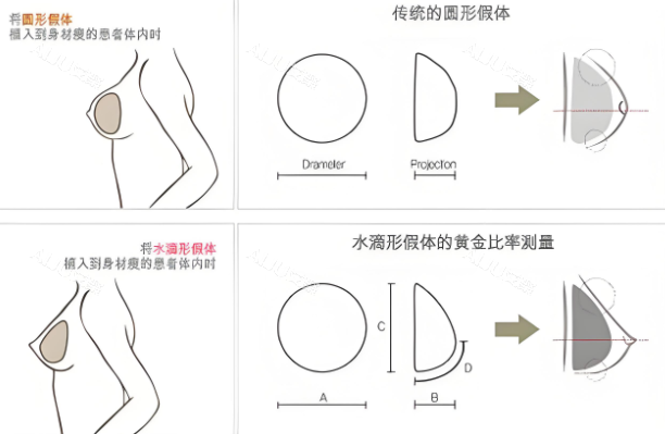 隆胸假体形状对比