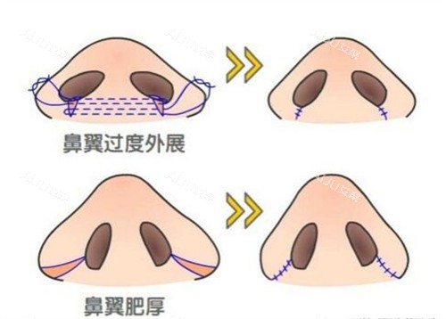 鼻翼缩小手术对比 鼻翼缩小手术对比