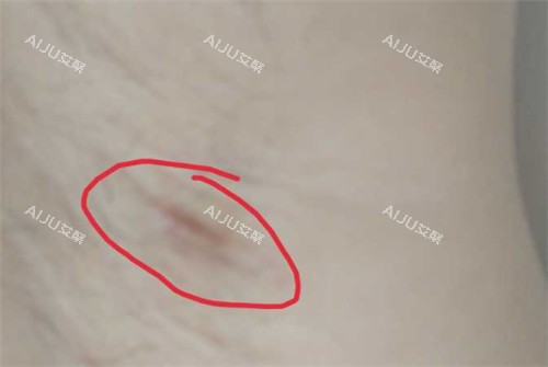 腋臭区域图 腋臭区域图