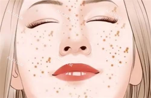 脸部有祛雀斑的示意图 脸部有祛雀斑的示意图