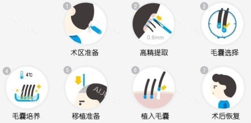 植发过程图解 植发过程图解