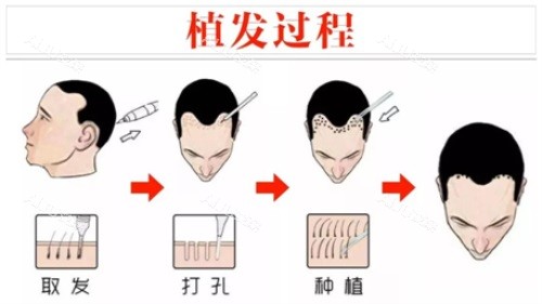 植发过程示意图 植发过程示意图