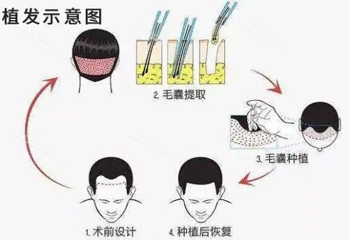 植发示意图 植发示意图
