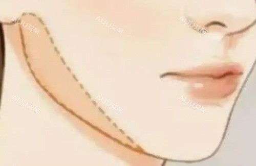 下颚缘提升示意图 下颚缘提升示意图